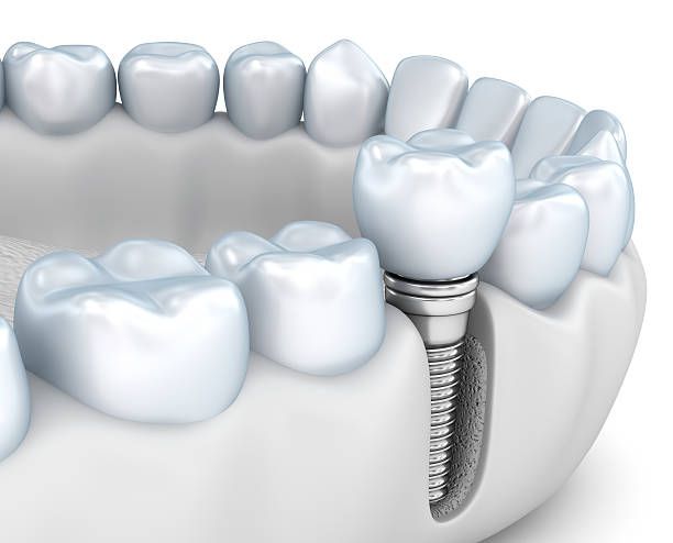 Clínica Dental Hnos. Argüello implantes dentales 1