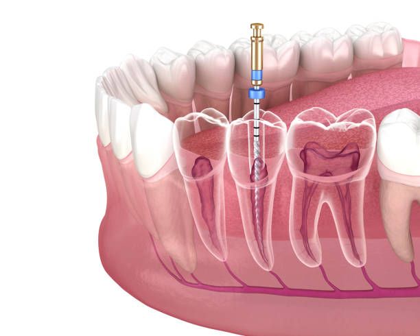 Clínica Dental Hnos. Argüello explicación de la endodoncia 