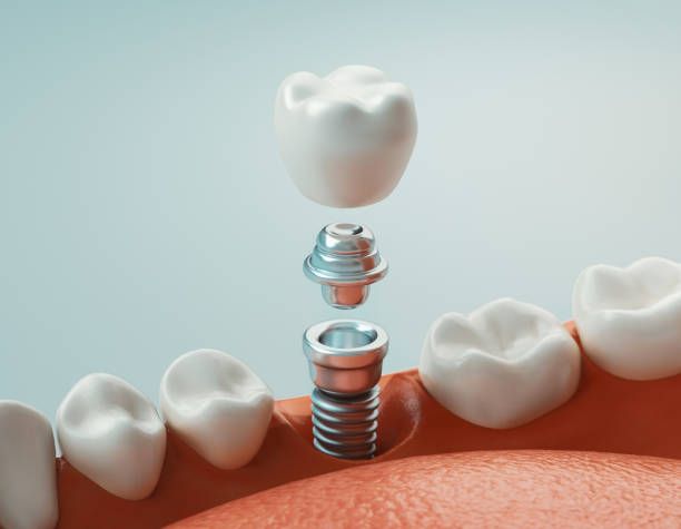 Clínica Dental Hnos. Argüello implantes dentales 2